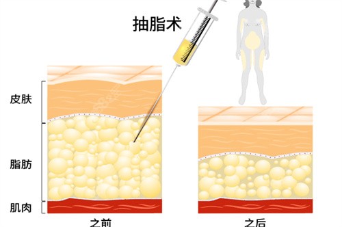 深圳富华医疗整形医院吸脂