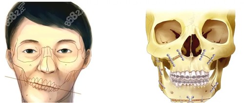 正颌手术前后动画图
