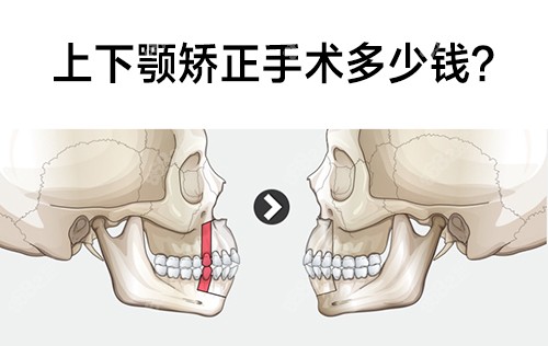 上下颚矫正手术多少钱？请看韩国双鄂手术的价格费用详情