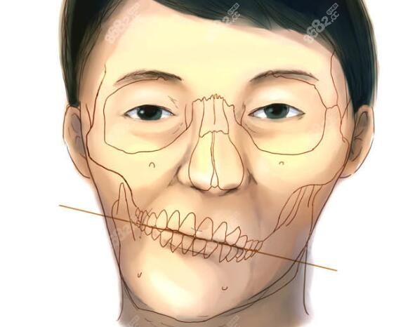 下頜骨不對稱矯正牙齒可以解決嗎?