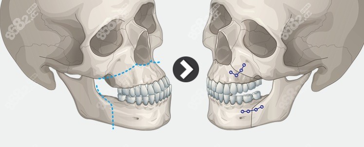 双鄂手术