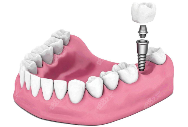 上海天佑口腔种植牙价格不高医生也不错m.8682.cc