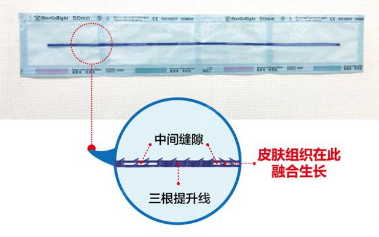 朴明旭的小切口三重提升术使用的线材