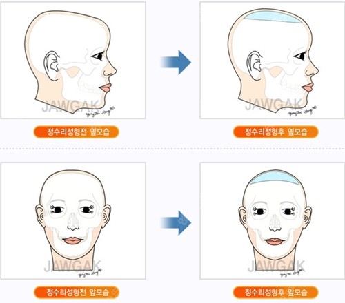 韩国雕刻整形外科医院骨水泥填充后脑勺怎么样？