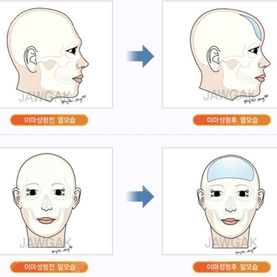 宋龙泰医生做骨水泥填充额头的原理图