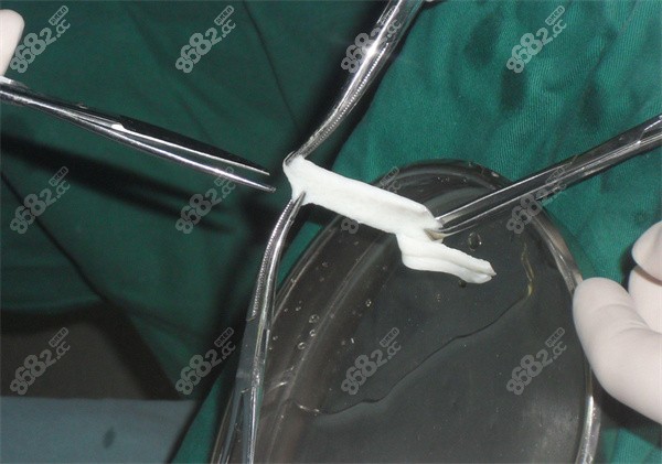生物补片能不能摸到