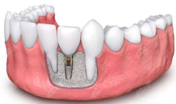 苏州美奥口腔医院种植牙
