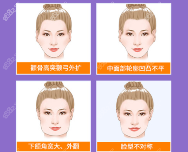 颧骨内推3年后的真实感受分享