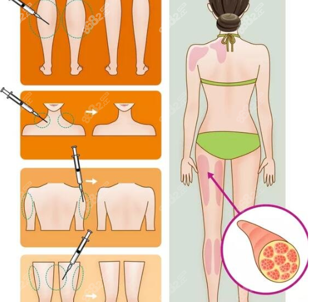 吸脂手术图示