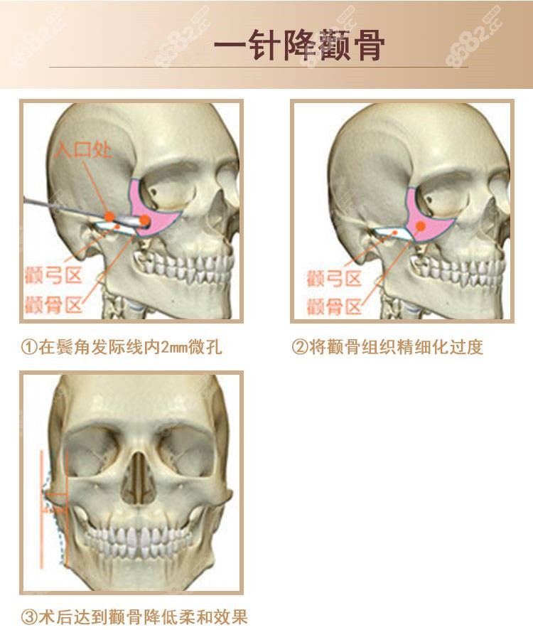 一针降颧骨颧弓手术过程