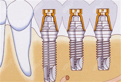 不同规格种植牙安装动画图