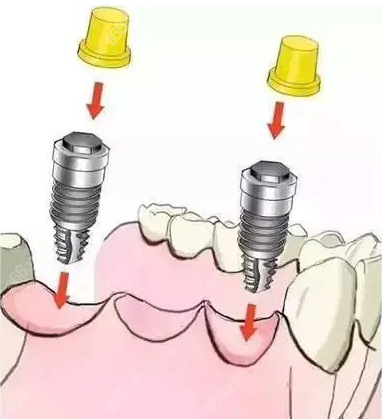 种植牙半口2万多靠谱吗www.8682.cc