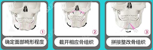 何锦泉正颌手术根据不同症状和畸形程度设计专属手术方案