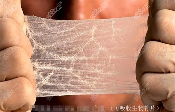 生物补片隆胸到底有没有用