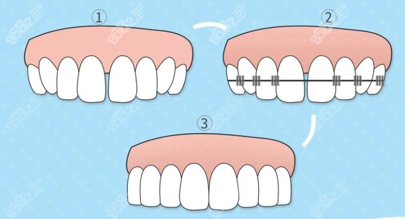 矫正牙齿过程图