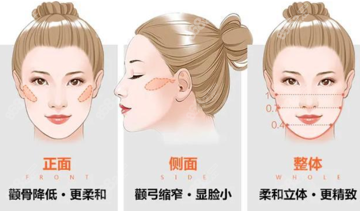 颧骨内推术后是不是更容易老