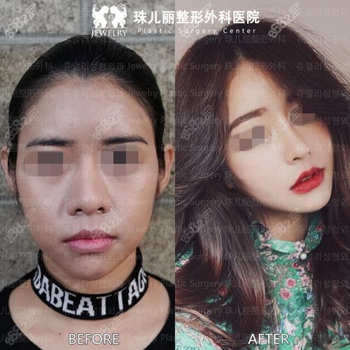 韩国珠儿丽整形外科轮廓对比照