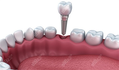 单颗种植牙安装动画图