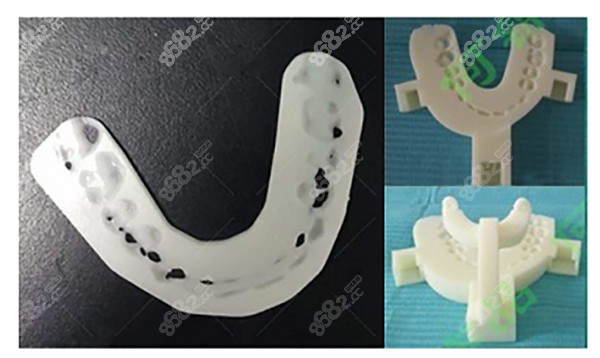 何锦泉3D导板正颌直术内窥镜辅助