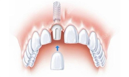 种植牙安装牙冠演示图