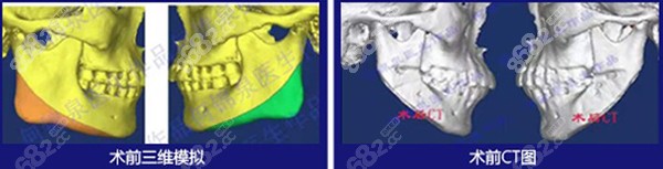 何锦泉正颌手术术前3D导板设计