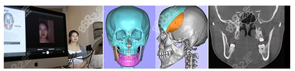 何锦泉全新3D数字化颌面导板正颌矫正技术