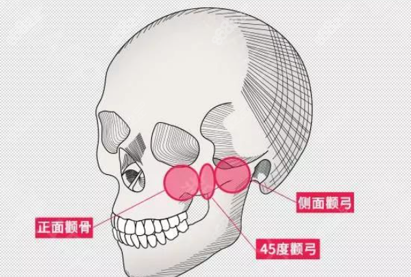 颧骨内推术后会不会反弹