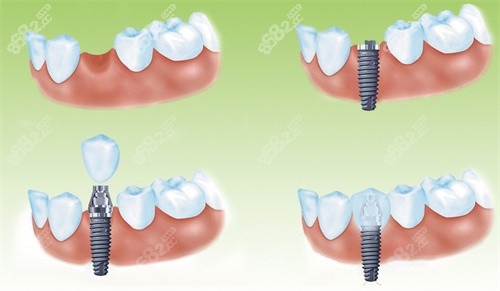 种植牙流程展示图