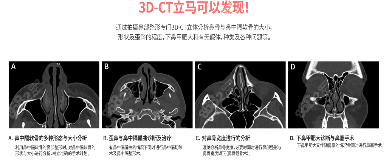 任荣旻肋骨鼻修复技术好在会利用3D-CT分析隆鼻失败问题