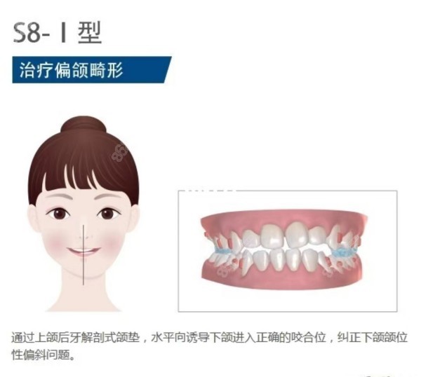 比如偏颌做掩饰性正畸的成效就不大