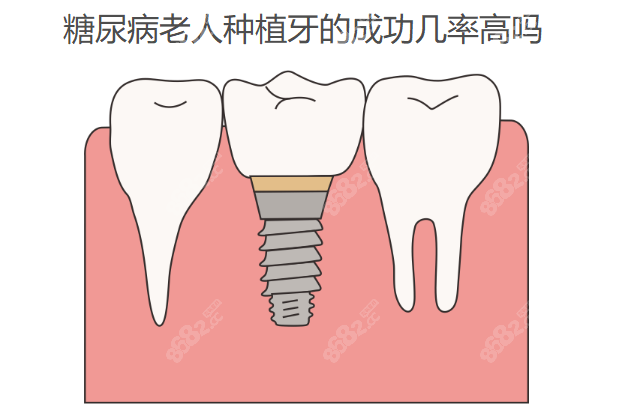 糖尿病老人种植牙的成功几率高吗www.8682.cc