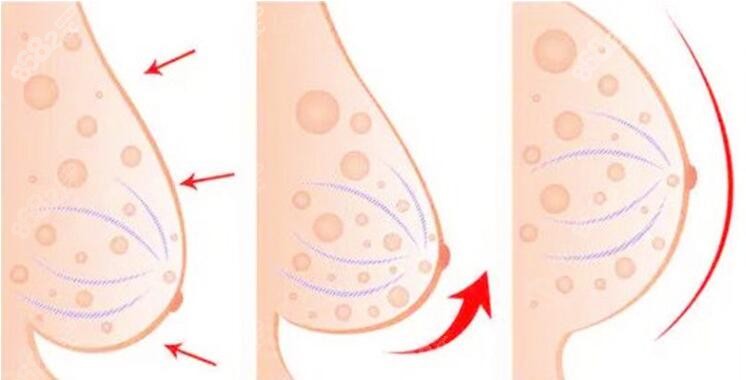 不开刀人工韧带乳房提升术对比图