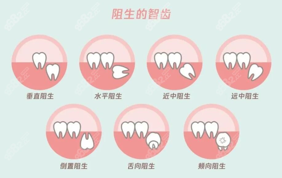 拔各种阻生智齿的难度