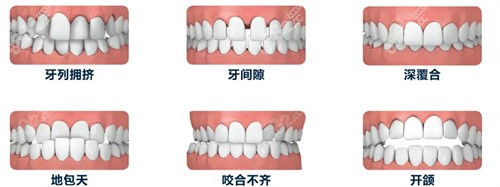 牙齿矫正问题罗列图