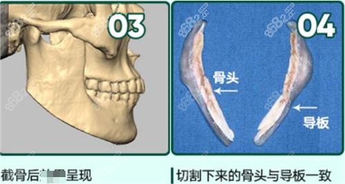 广州紫馨磨骨医生沈绍勇介绍