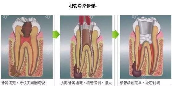 大牙烂了个大窟窿疼做根管治疗