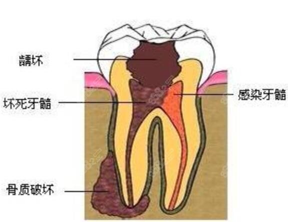 大牙烂了个大窟窿疼拔掉还补牙m.8682.cc