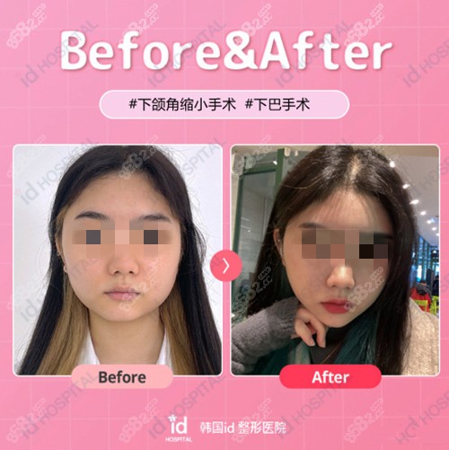 李知赫院长下颌角磨骨实例