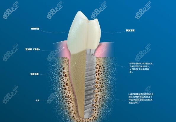 德国朗斯种植牙多少钱一颗