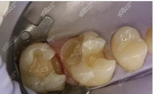 后牙补牙图片8682.cc