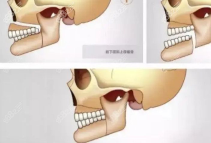 上颚矫正会使鼻子变长吗