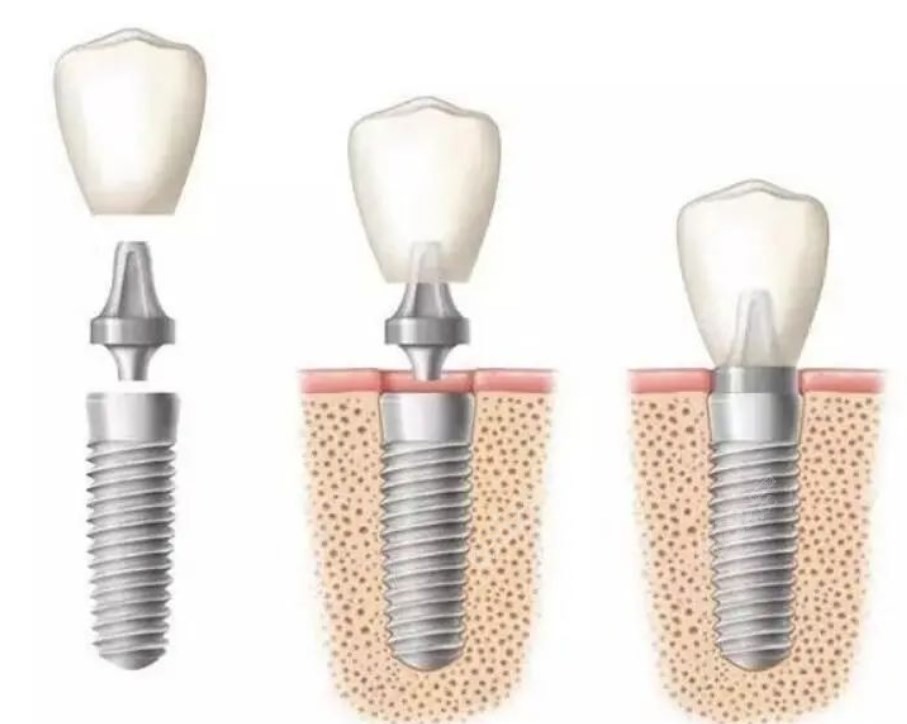 单颗种植牙