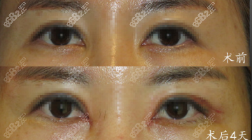 曹仁昌內眼角修復圖片
