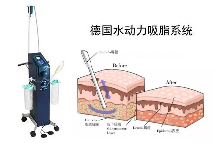 赵敬国医生做吸脂手术的原理图