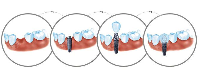无锡牙博士口腔种牙费用5000起