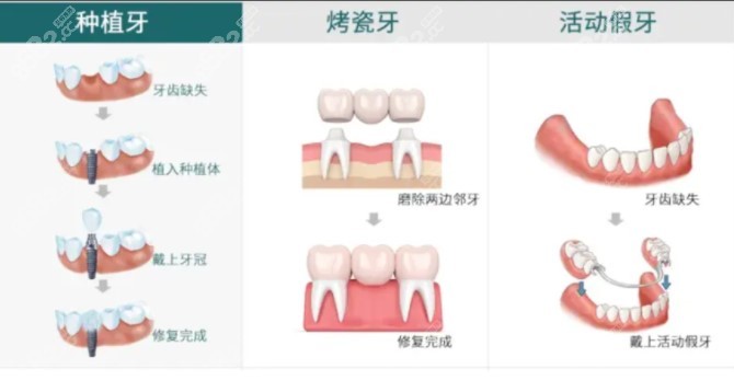 山东省种植牙价格调整了吗