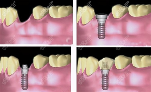 种植牙流程动画图