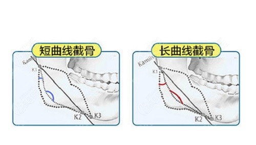 柳超医生磨骨技术到位