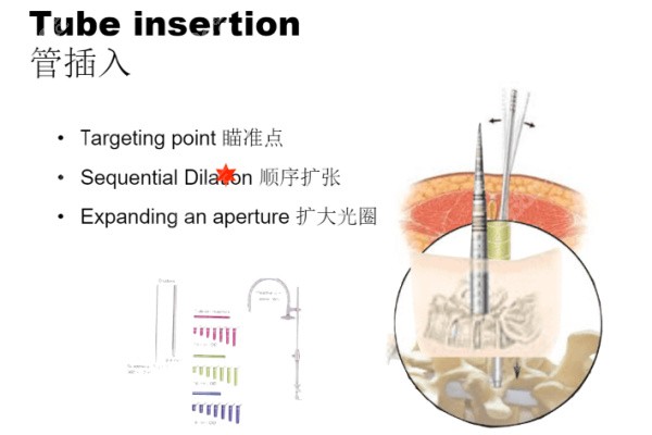 插管穿刺治疗脊椎病示意图