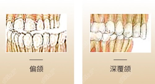 外科正牙手术靠谱吗